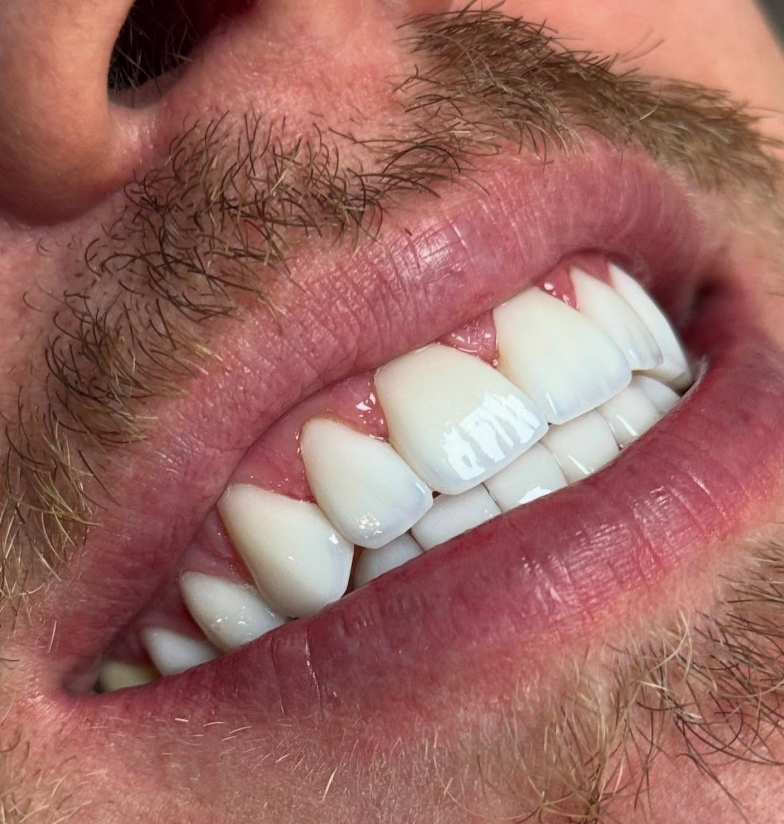 Resultado de estética dental — sorriso em close